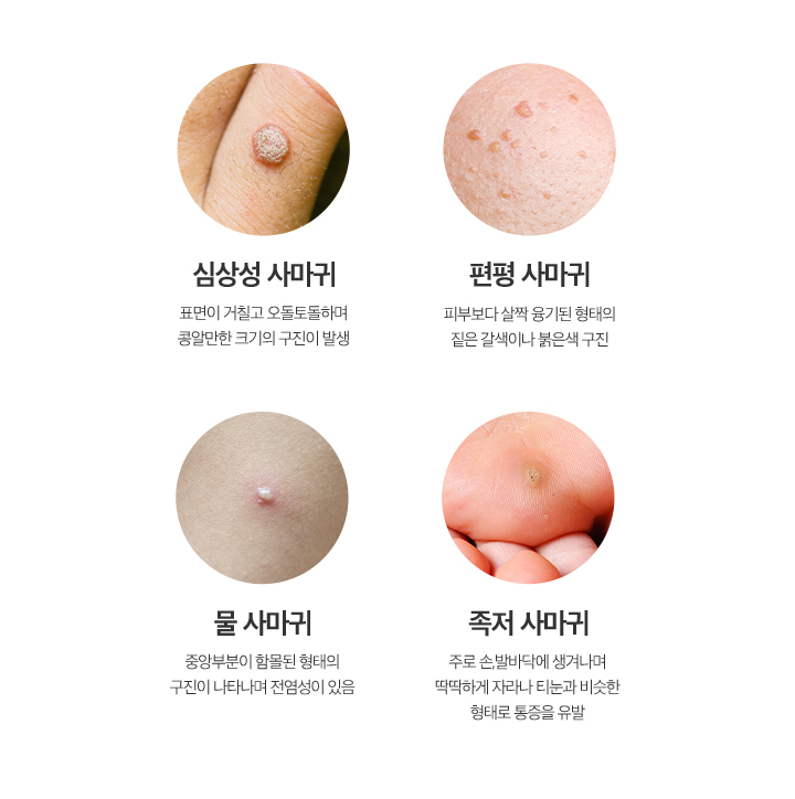 심상성사마귀/편평사마귀/물사마귀/족저사마귀