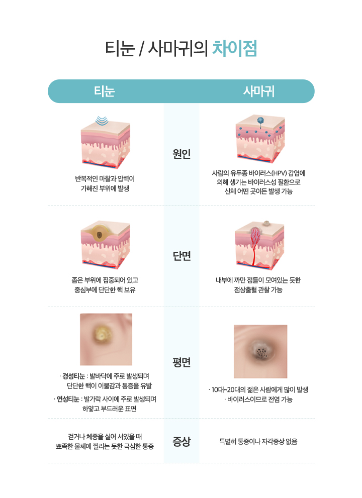 티눈/사마귀의 차이점