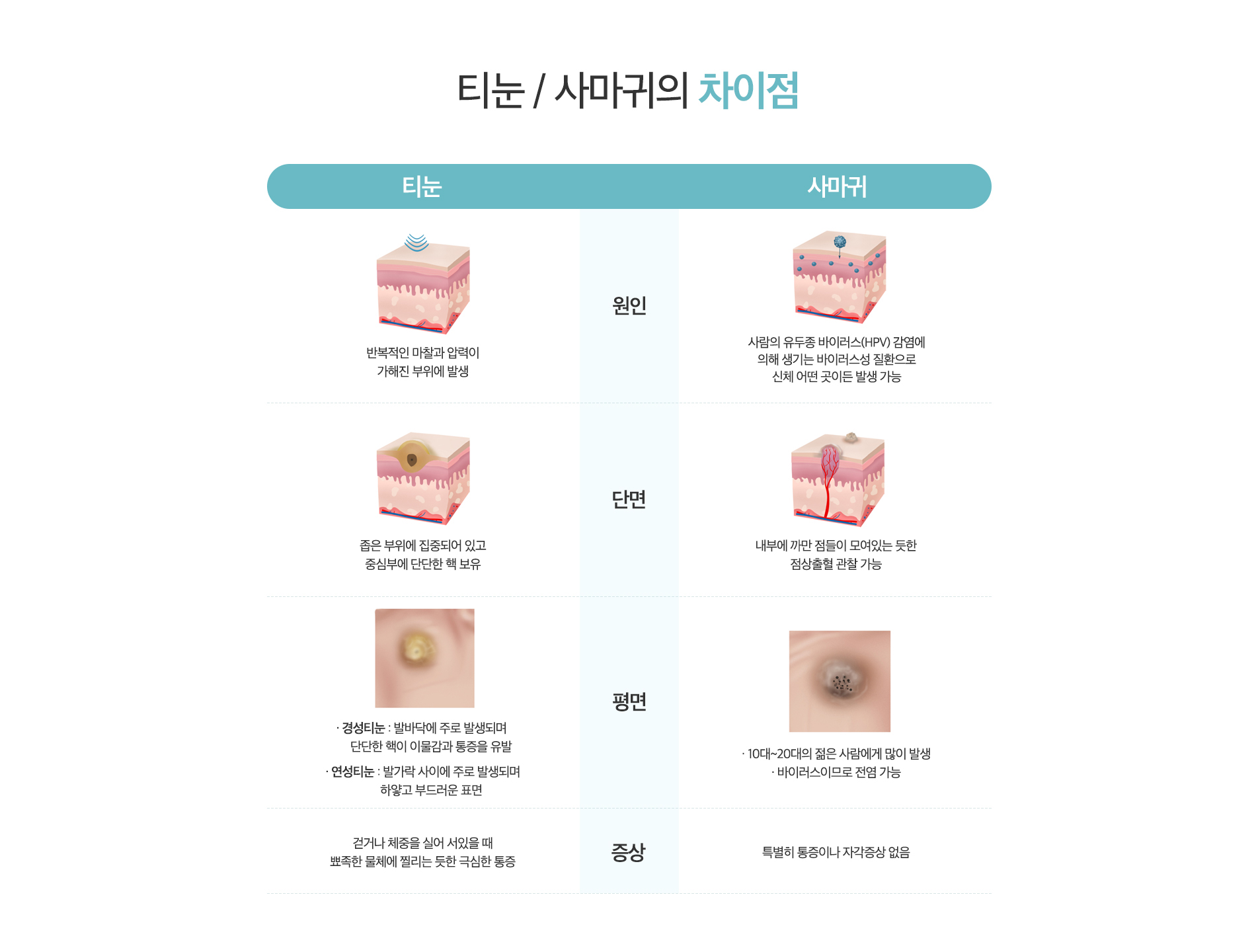티눈/사마귀의 차이점